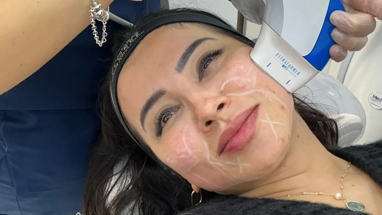 Ultraformer MPT en Bogotá: la nueva generación de lifting facial sin cirugía llega a Sandro Flórez