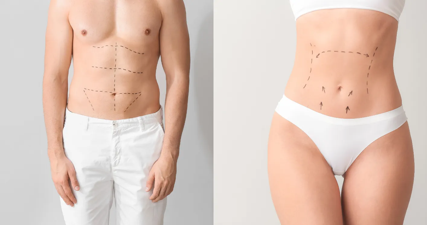 Liposuction & Liposculpture